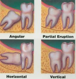 Wisdom Teeth Removal Berwick